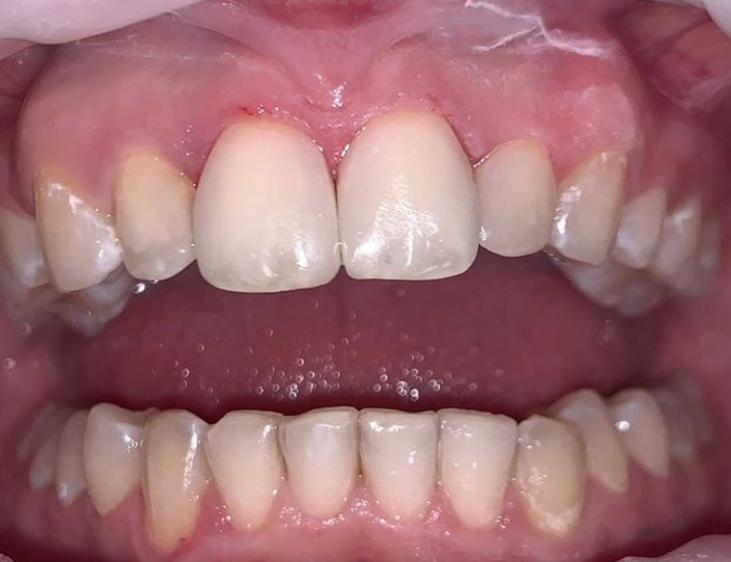 Кариесы на центральных зубах